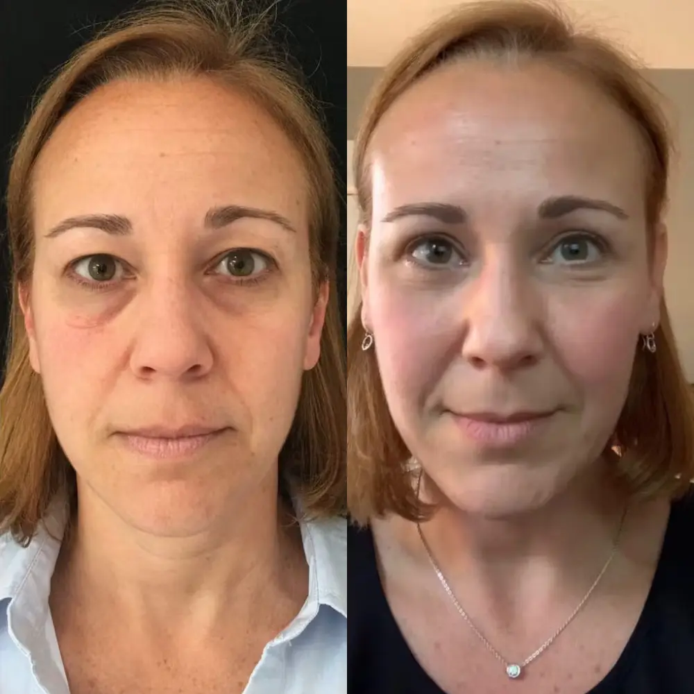 Rédelisse™ Red Light Eye Massager