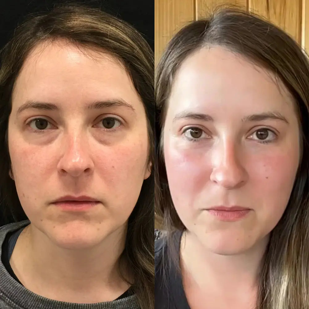 Rédelisse™ Red Light Eye Massager